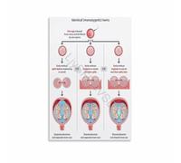 XGINERFEX Monochorionic Diamniotic Twins Chart Canvas Poster Placentation Reference Obstetrics Wall-Art Gift(Unframed,12x18inch(30x45cm))