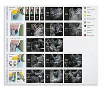 XGINERFEX Ultrasound Guide to Endometriosis Poster Pelvic Lesions and Imaging Features for Sonographers(Unframed,16x24inch(40x60cm))