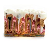 Xiaoxu Modelo de anatomía Dental para Caries, Modelo de evolución de la Caries con Modelos de patología Dental, para Estudio Oral y enseñanza Integral de la Estructura.