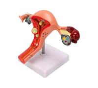 Xiuganpo Modelo de Ovario de útero Femenino, Modelo de útero Patológico con Fibromas Uterinos, Ovarios, Trompas de Falopio, de Anatomía del Humano para Estudio y Enseñanza de