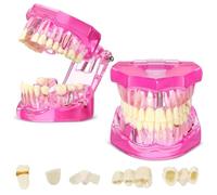 Yuattory Modelo de Dientes con Enfermedades Tipodontos Dentales Modelo de Dientes de Implante con Dientes Removibles Demostración Patológica (Rosa, 2 Piezas)