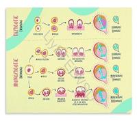 YZWRWRMKTB Placentation of Twins Educational Chart Poster Obstetric Department Wall-Art Canvas Print Ideal for Hospital Living Room Decor(Framed,08x12inch(20x30cm))