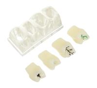 Zerodeko Modelo de Diente Caries Oral Realista de Abs para Enseñanza de Higiene Bucal y Comunicación Pacientes en Educación Dental