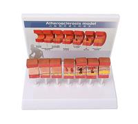 ZJchao Herramientas de Estudio de Anatomía y Fisiología, 7 Piezas Modelo de Anatomía de la Arteria Modelo de Humana Vaso Anatómico Aterosclerosis Trombo Vascular de Esqueleto para Estudiar